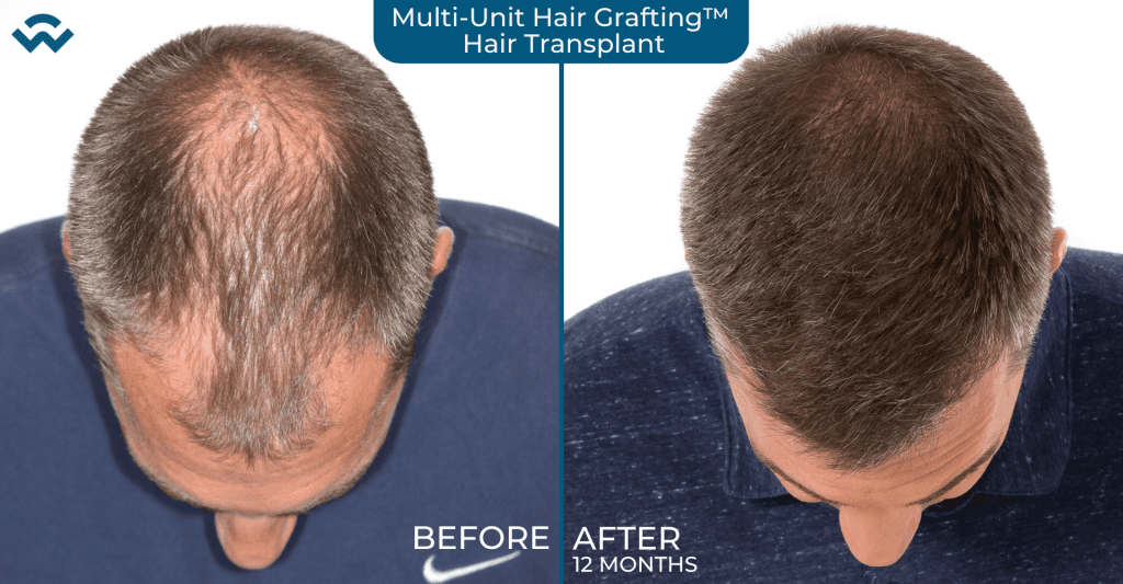 What to expect Hair Transplant Multi Unit Hair Grafting