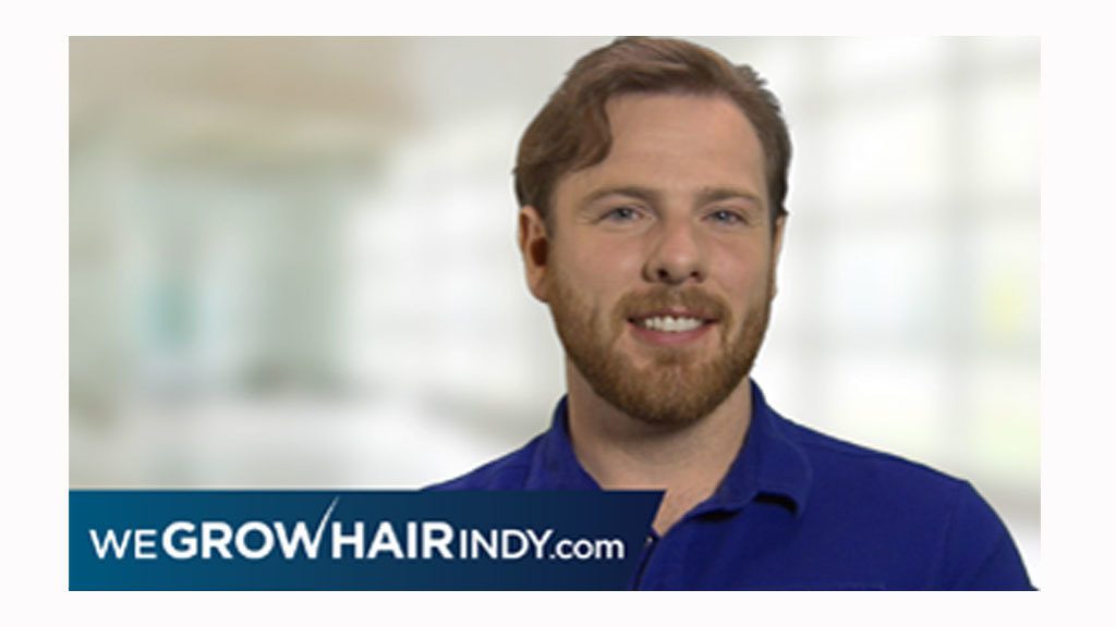 January Feat. Hair Transplant Client Results - Sean