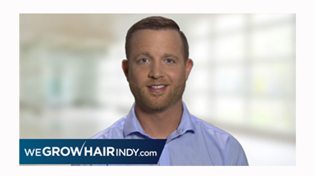 March Featured Client Amazing Hair Transplant Results – Jonathan