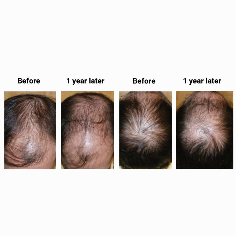 Prevent More Hair Loss Hair Loss Treatment