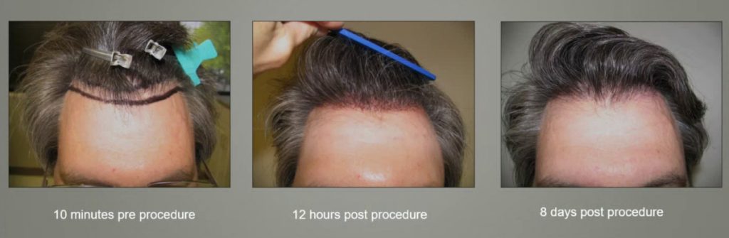 What to Expect 10 Days After Hair a Transplant