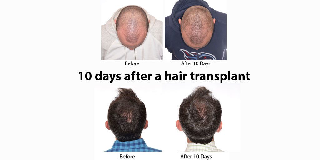 before and after hair transplant 10 days