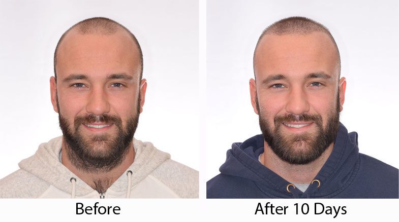 what does it look like 10 days after hair transplant
