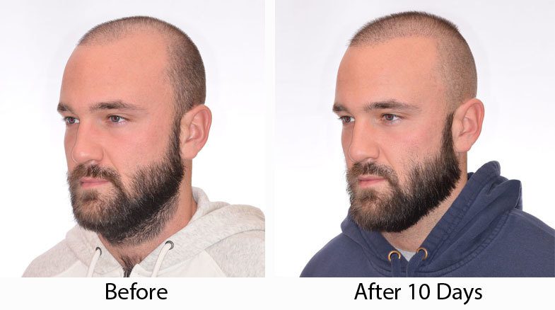 10 days after a hair transplant at we grow hair indy