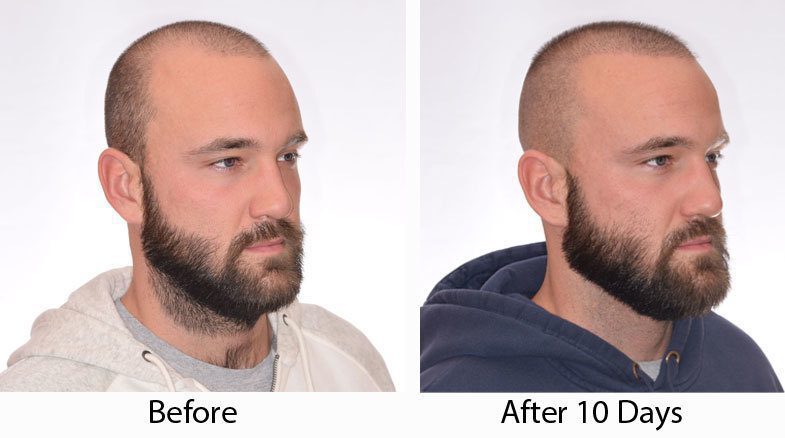 hair transplant AFTER 10 days