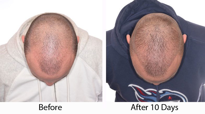 How scalp look after 10th day of Hair Transplant?