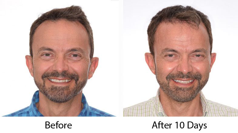 10 Days After Hair a Transplant Procedure