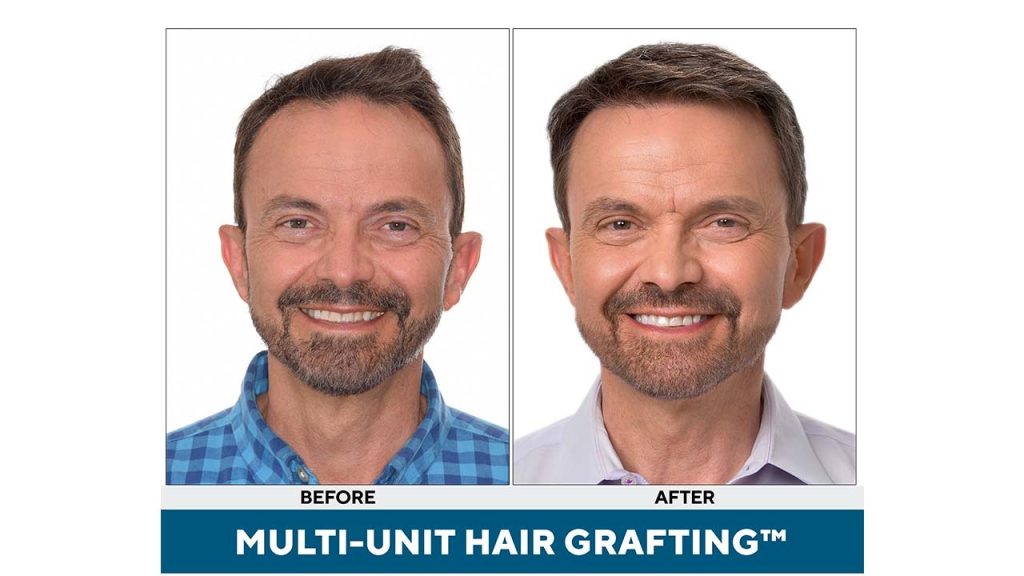 What to Expect After a Multi-Unit Hair Grafting™ Transplant paul poteet