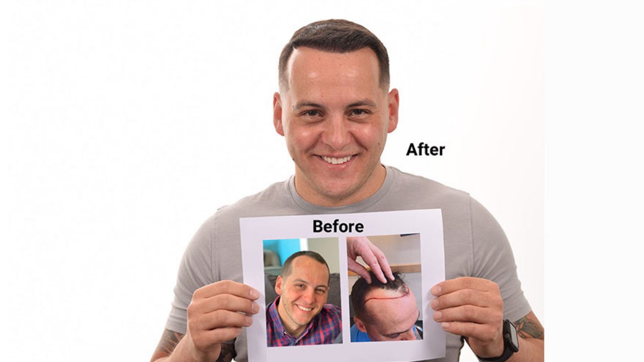 second hair transplant results