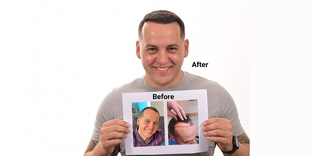 before and after second procedure hair transplant