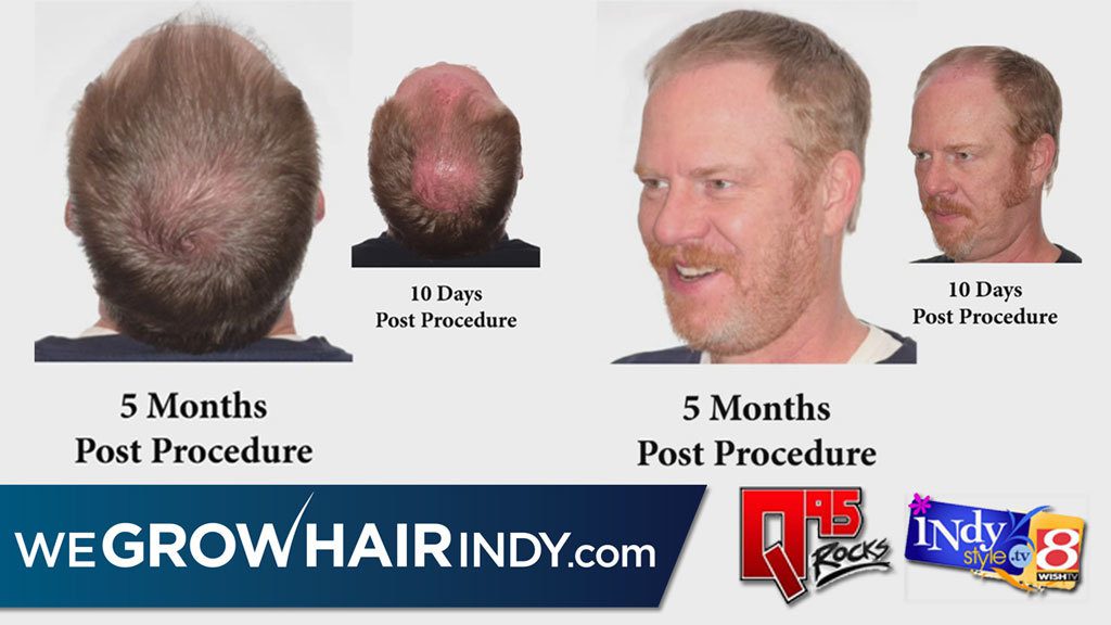 Gunner q95 3 hair Transplant results