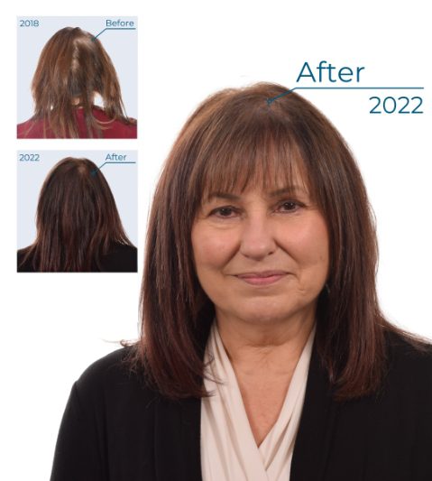 Ann Richards Hair Loss Treatments