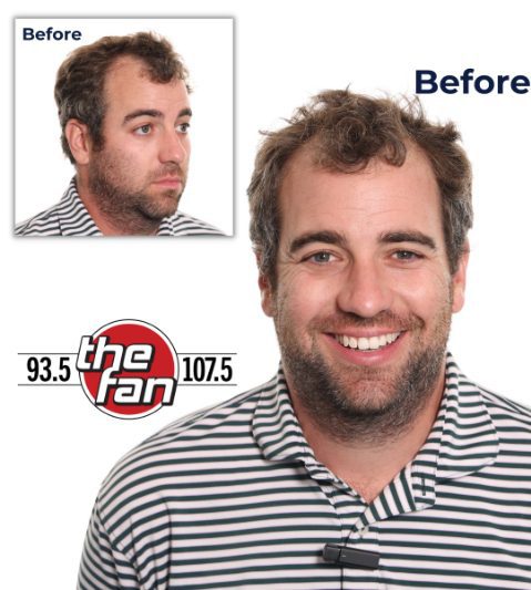 Kevin Bowen FUE Hair Transplant Before