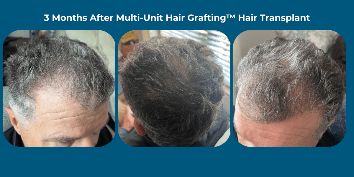 3 months after hair transplant barry krauss