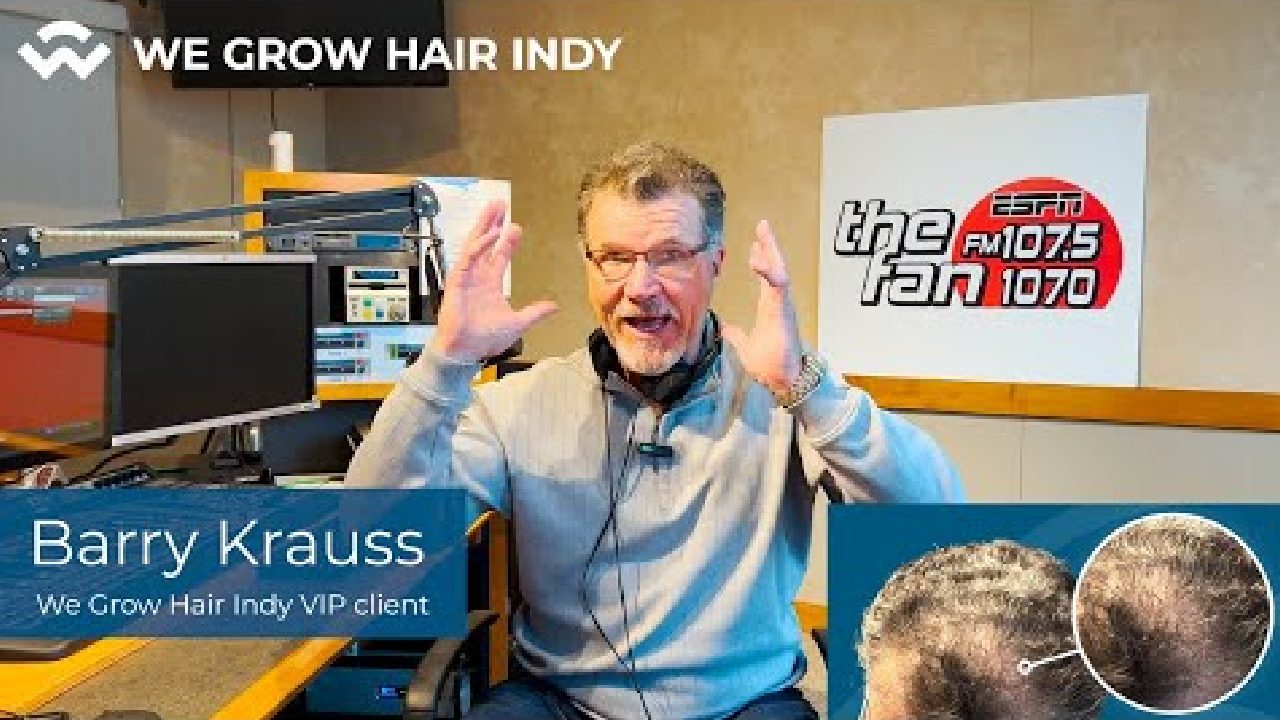 Barry Krauss Hair Loss Story - We Grow Hair Indy's Newest VIP Hair Transplant Client