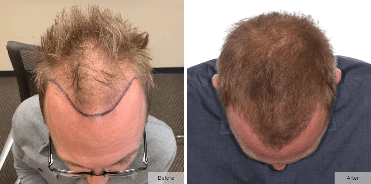 Crate 4 Months after Hair Transplant results at we grow hair indy