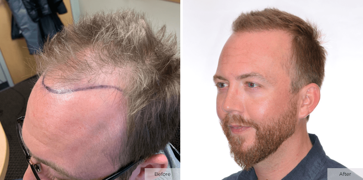 Crate 4 Months after Hair Transplant at we grow hair indy