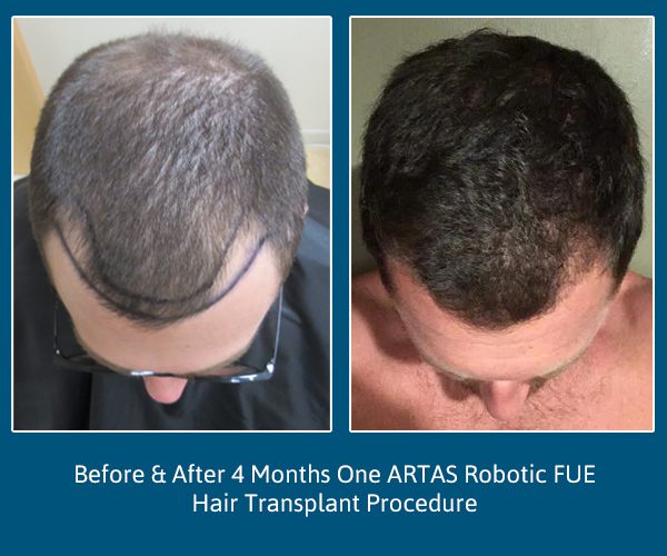 Hair Transplant after 4 Months Before and After Just-PAI