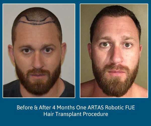 Hair Transplant after 4 Months Before and After Justin-Front