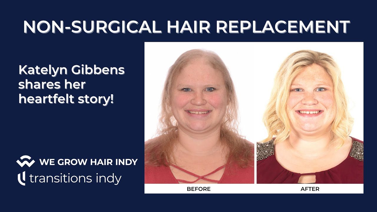 Non-Surgical Hair Replacement - Katelyn's Heartfelt Story