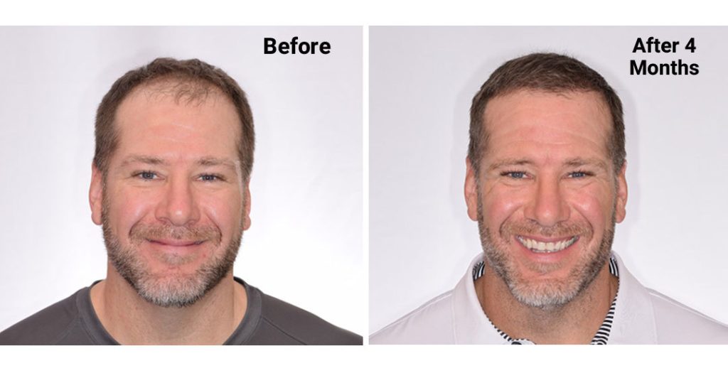 Rick DeMulling 4 Month Hair Transplant Update Rick Front BA