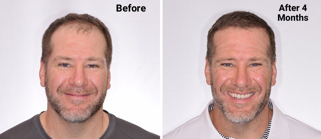 Rick DeMulling 4 Month Hair Transplant Update