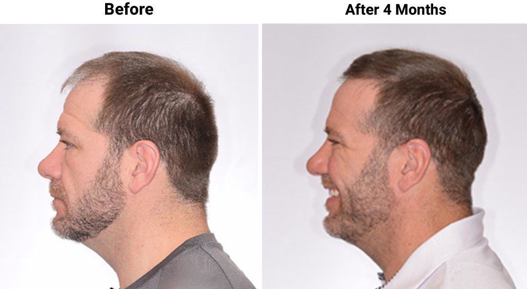 Rick DeMulling 4 Month Hair Transplant
