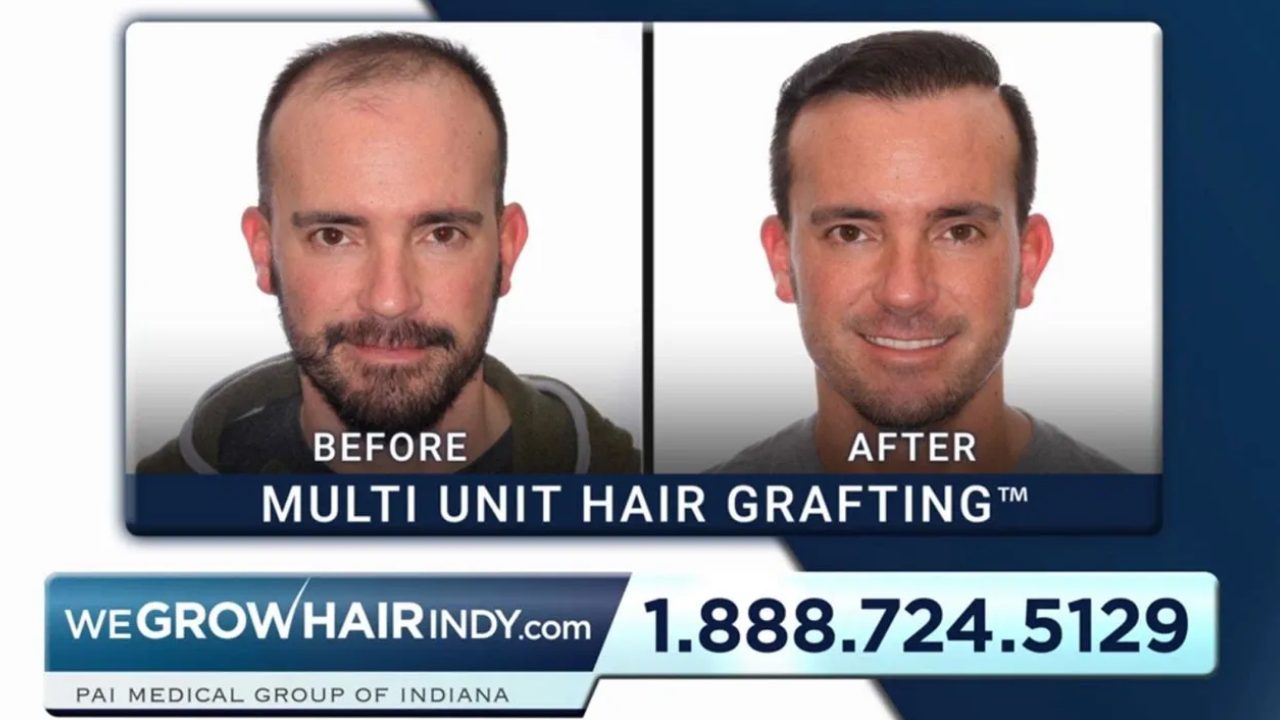 We Grow Hair Indy Hair Transplant Solutions | Indianapolis, IN