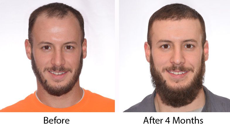 4 months after hair transplant
