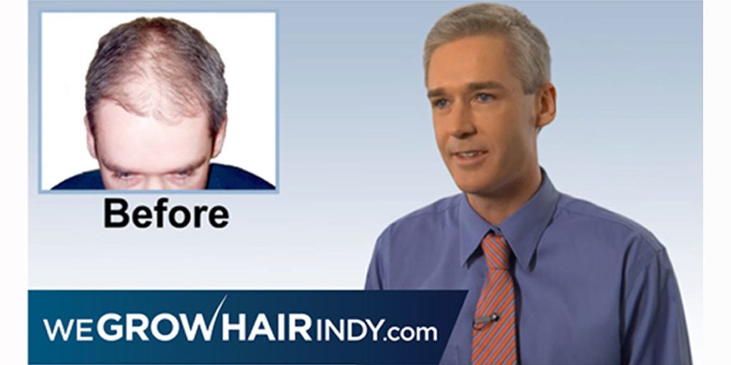 Darren Hair Transplant before and after