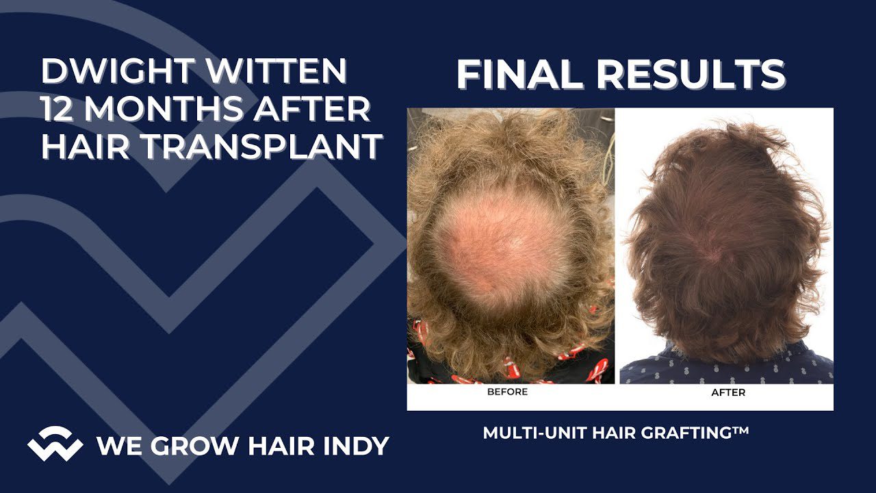 dwight witten hair transplant before and after