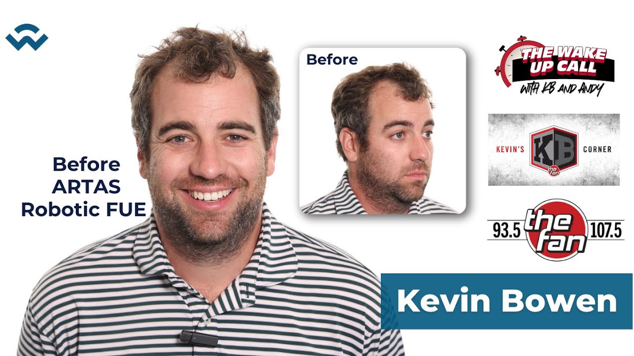Introducing Kevin Bowen - We Grow Hair Indy's Newest VIP Hair Transplant Client