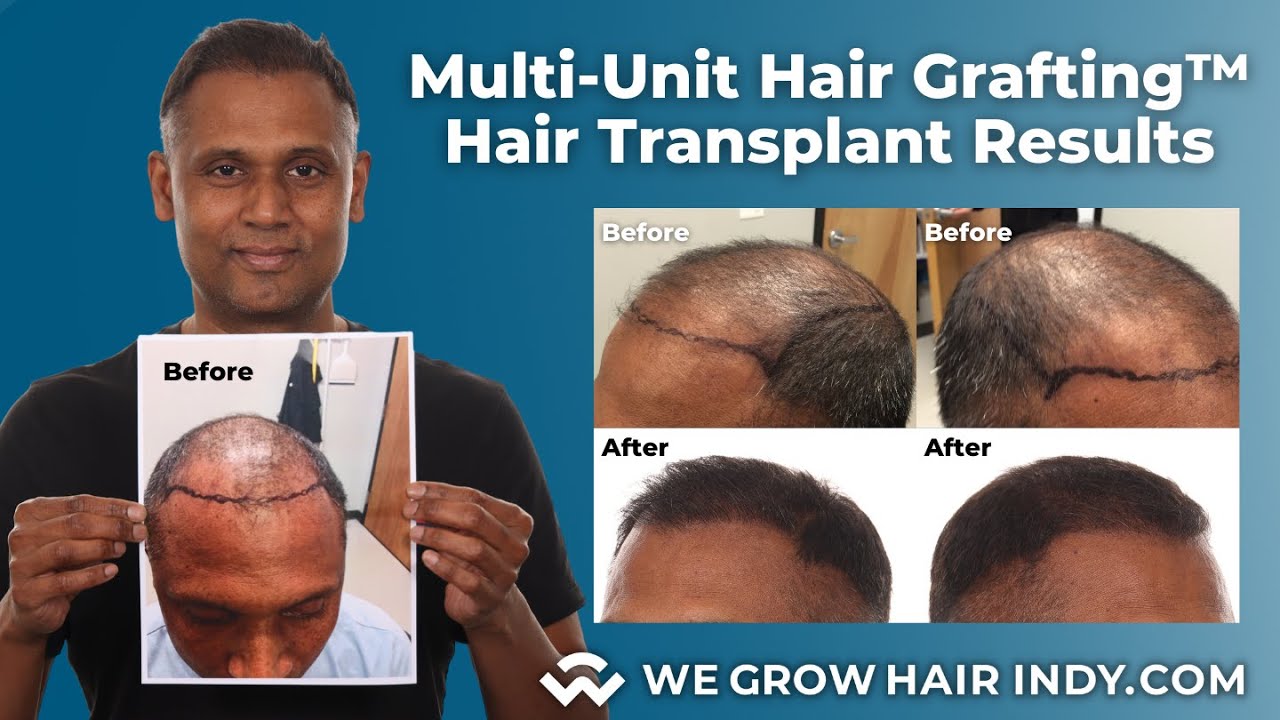 Kash is back 12 months after his Multi-Unit Hair Grafting™ Hair Transplant at We Grow Hair Indy!