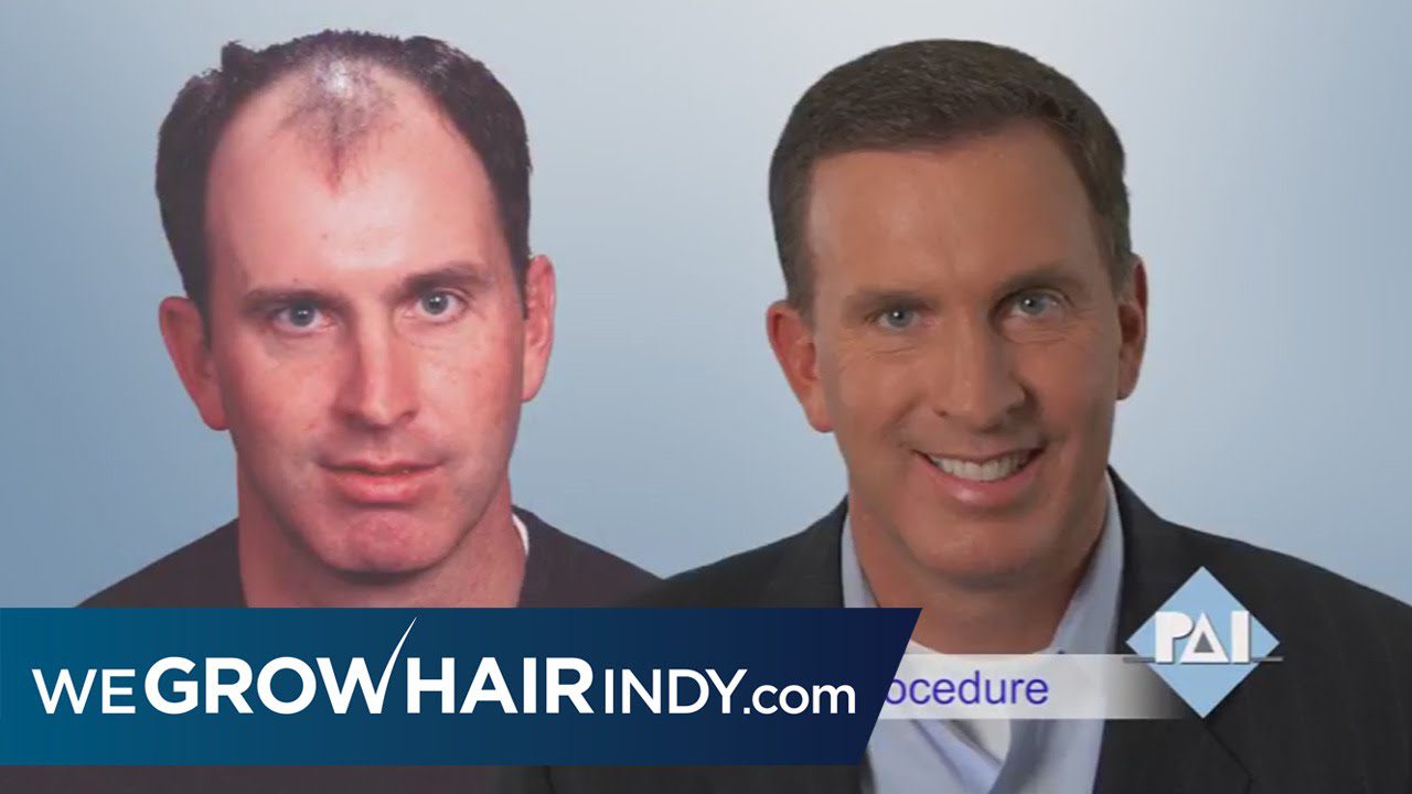 What Makes We Grow Hair Indy different