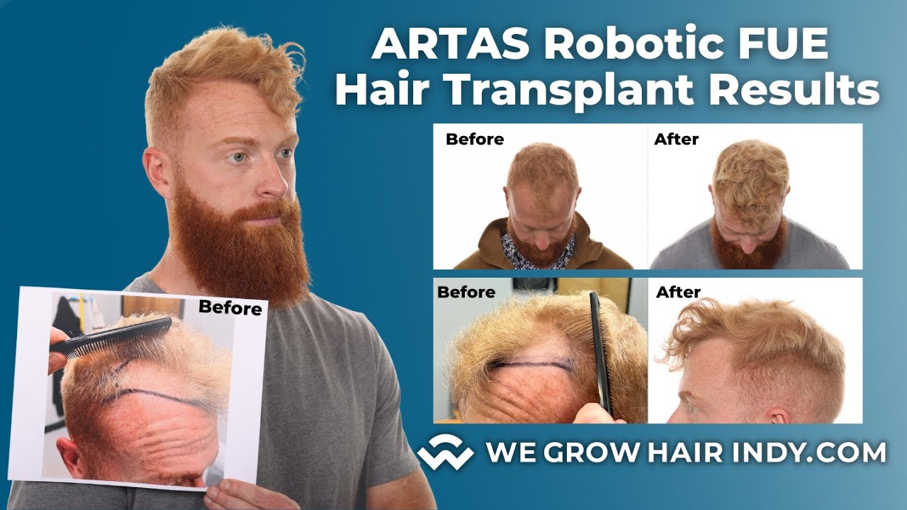 Remarkable ARTAS Robotic FUE Hair Restoration Journey with We Grow Hair Indy - 12 Months After