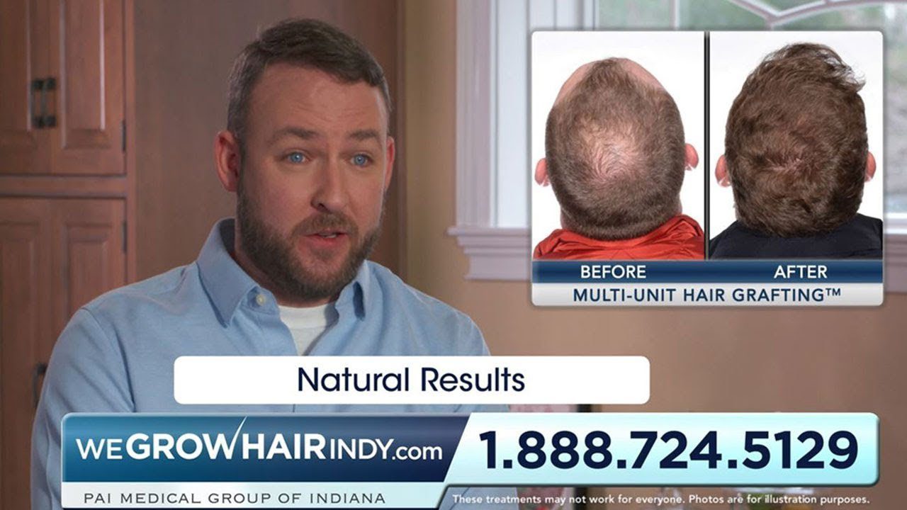 Natural Hair Transplant results