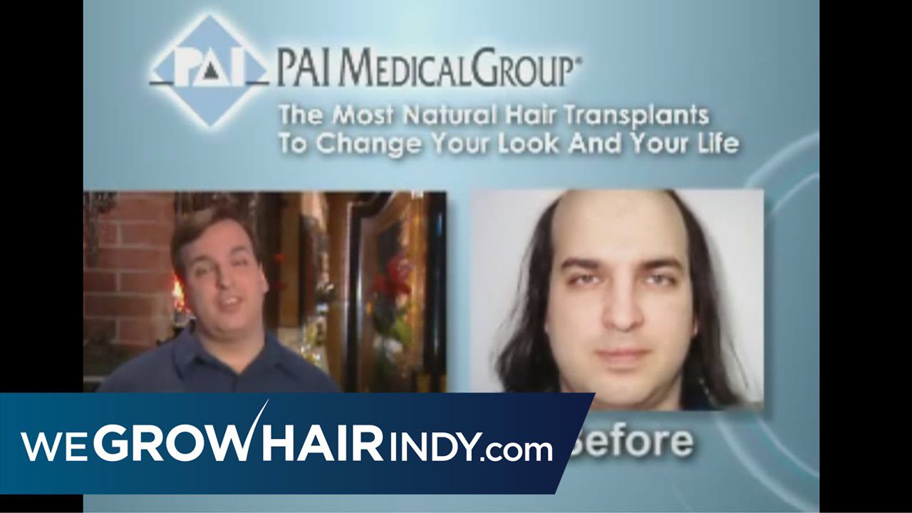 Hair Transplant Guaranteed Natural Look