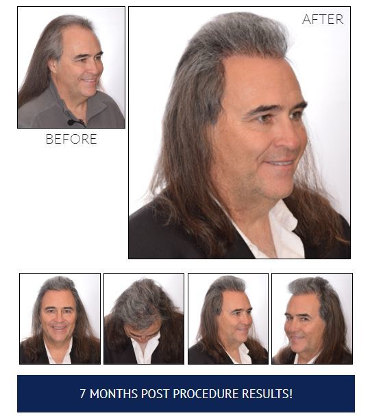 7 months after hair transplant don stuck