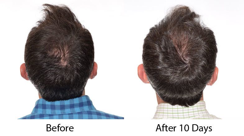 what to expect 10 days after a fut hair transplant