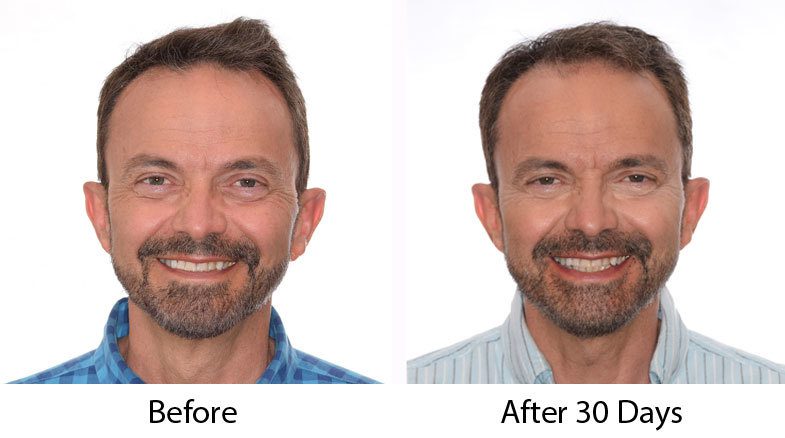 what to expect 30 days after a hair transplant