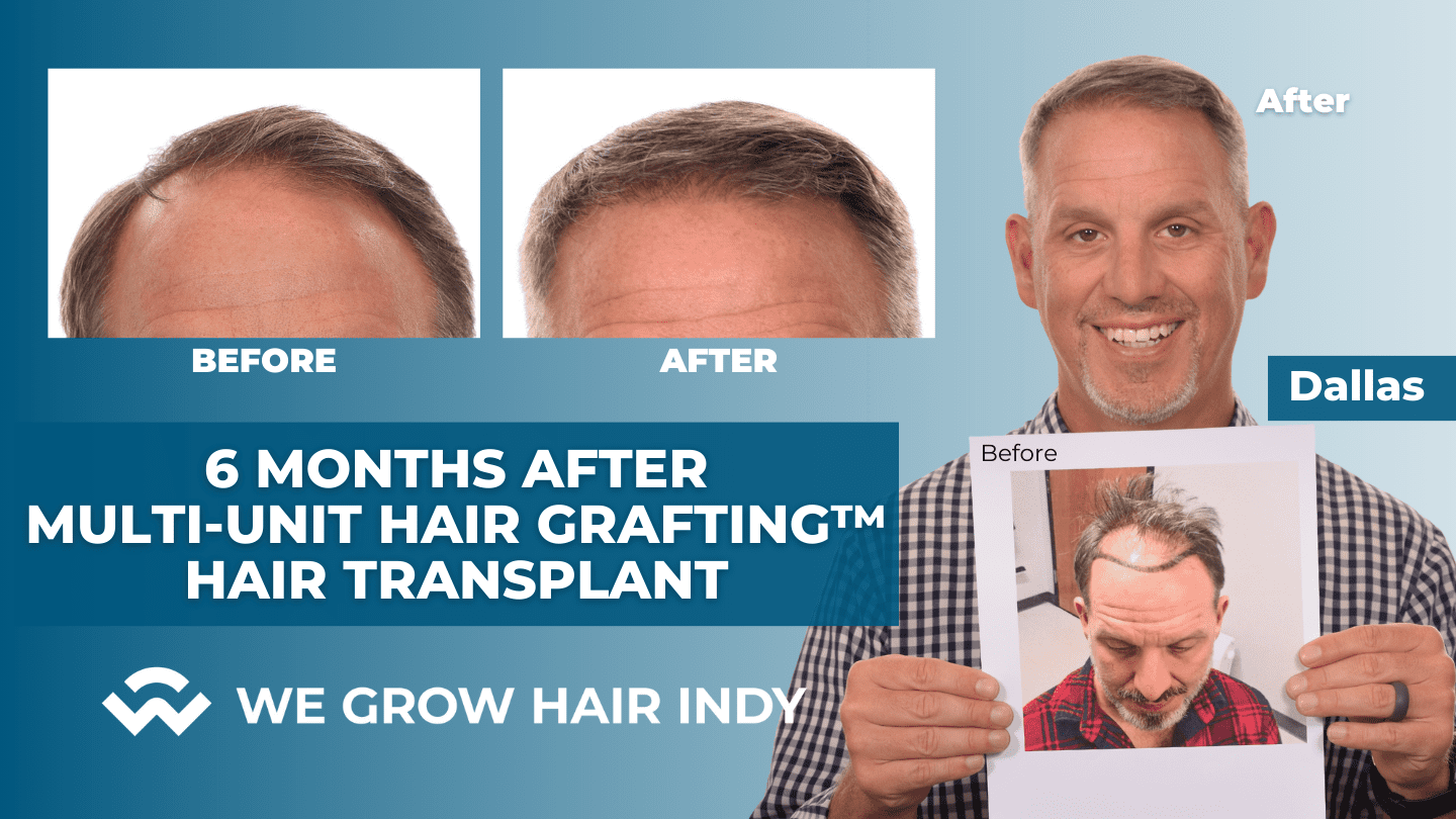 Dallas – 6 Months After Multi-Unit Hair Grafting™ Hair Transplant – Looking Amazing!