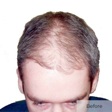 Hair Transplant Before and After Darren Andrews - Before Image - New