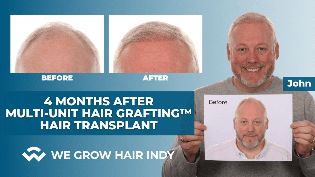 John Hair Transplant Results