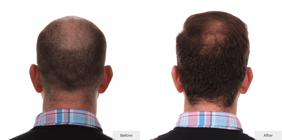 Hair Transplant Before and After Matthew Derado Back B&A