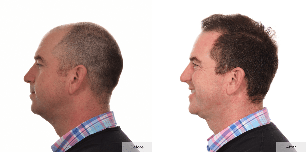 Hair Transplant Before and After Matthew Derado Left Side B&A