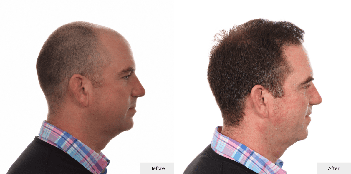 Hair Transplant Before and After Matthew Derado Right Side B&A