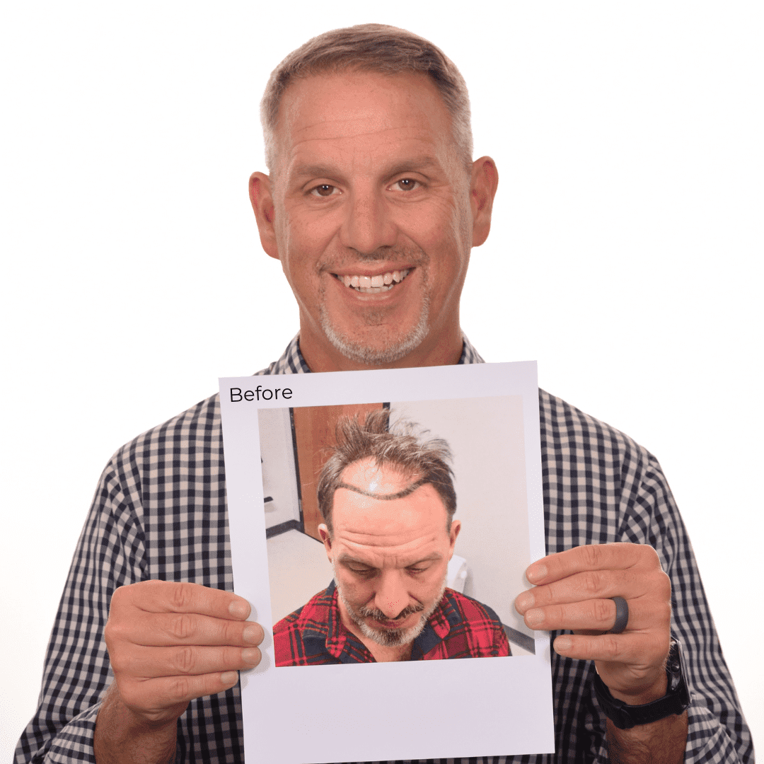 Hair Transplant Before & After Dallas Harshfield