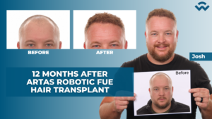 1 Year After Hair Transplant