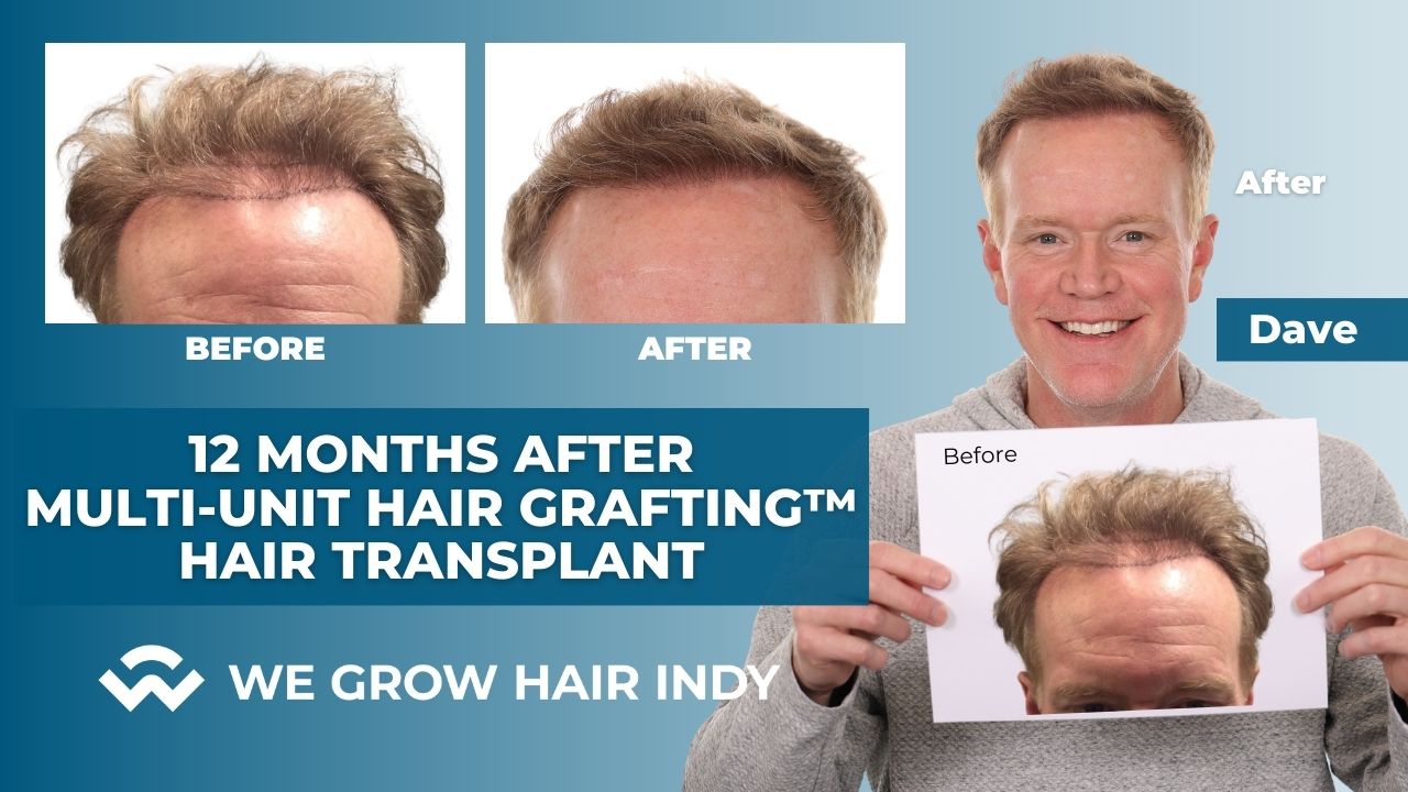 Hair Transplant Results – Dave Furst – Multi-Unit Hair Grafting™