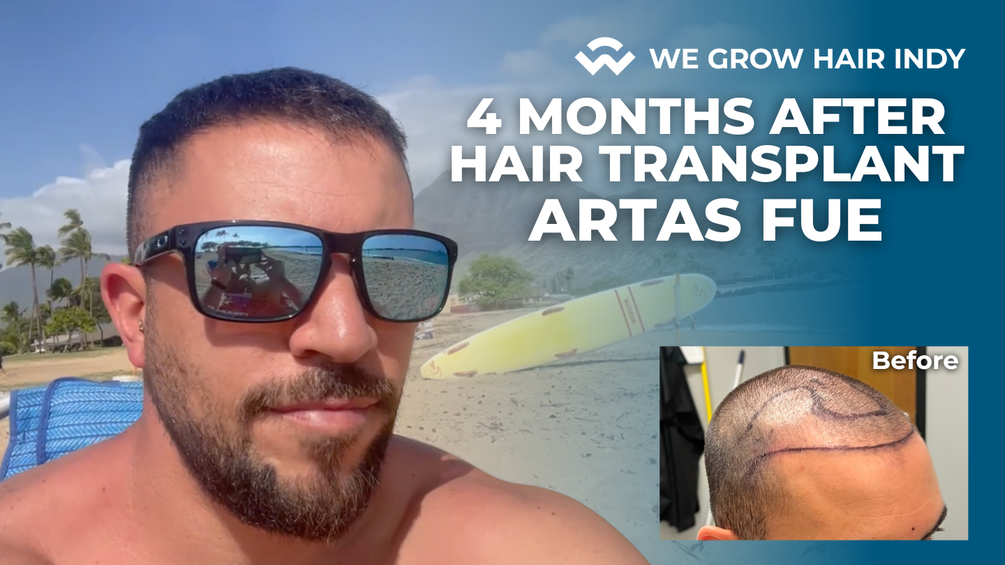 4 Months after ARTAS Robotic FUE Hair Transplant – We Grow Hair Indy